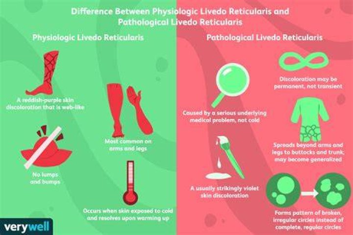 How do you treat Livedo Reticularis?