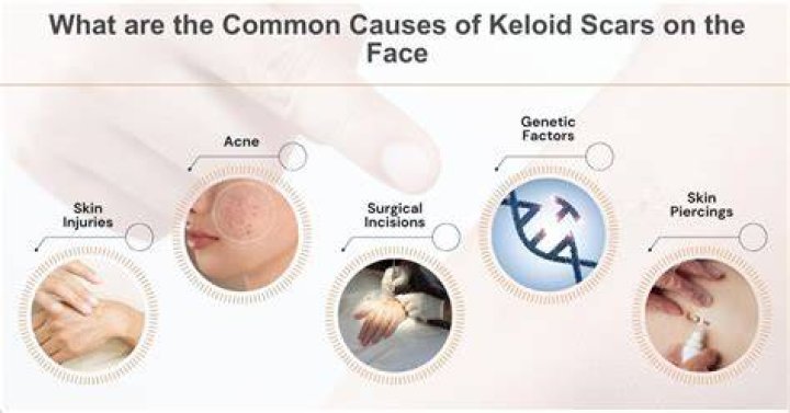 What causes keloid scars?